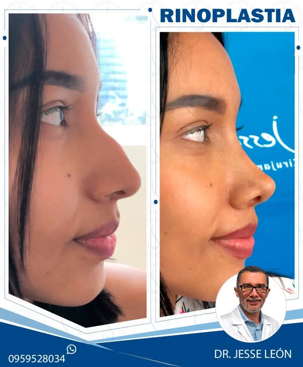 Rinoplastia antes y después